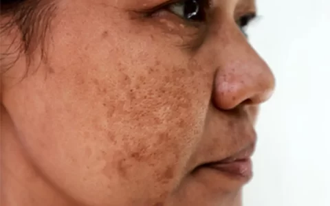 Melasma