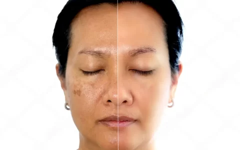 Tratamento para melasma
