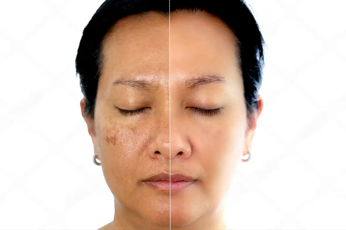 Tratamento para melasma